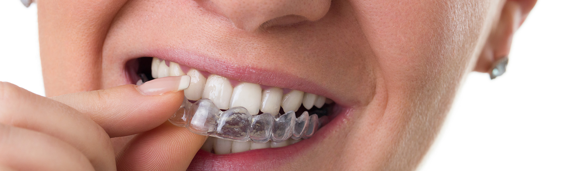 How to Keep Retainers Clean in the Winter