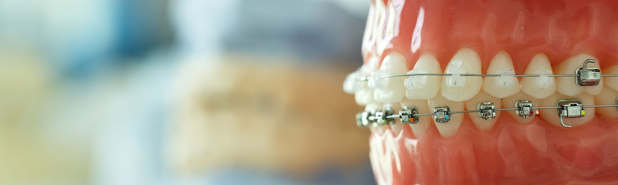 Types of Braces: Which One is Right for You Blog Image
