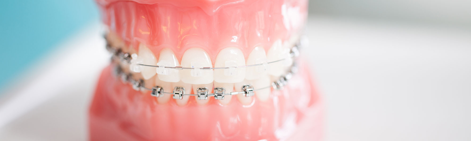 What to Consider When Deciding Between Traditional Braces and Clear Aligners Blog Image