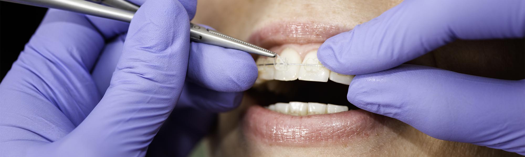 Porcelain Ceramic Braces Treatment in Long Beach CA