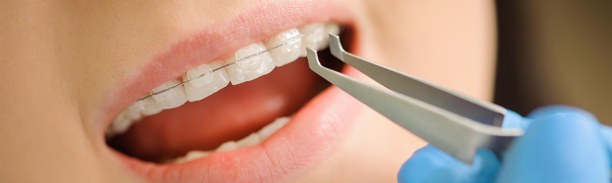 Porcelain Ceramic Braces in Long Beach CA