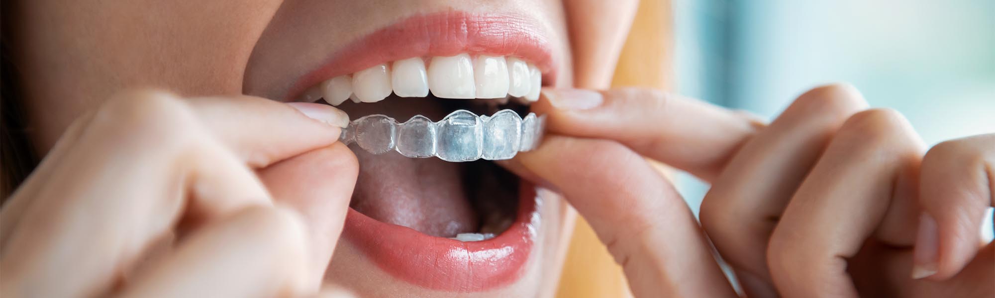 Orthodontics Retainers Long Beach CA